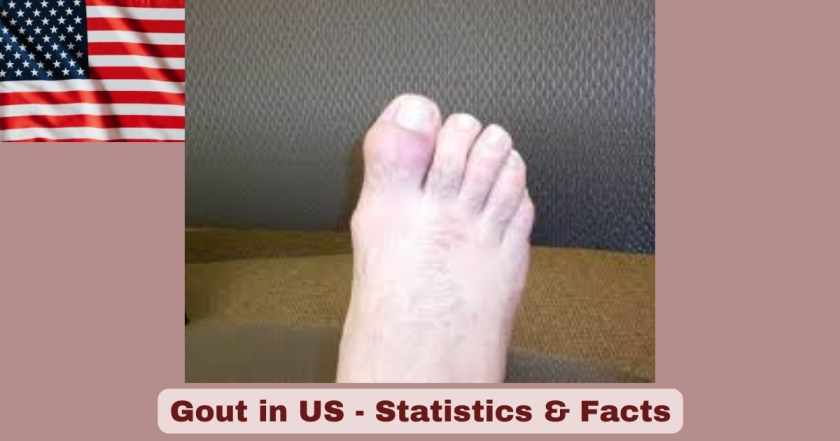 Gout in US