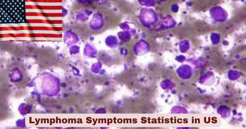 Lymphoma Symptoms in US