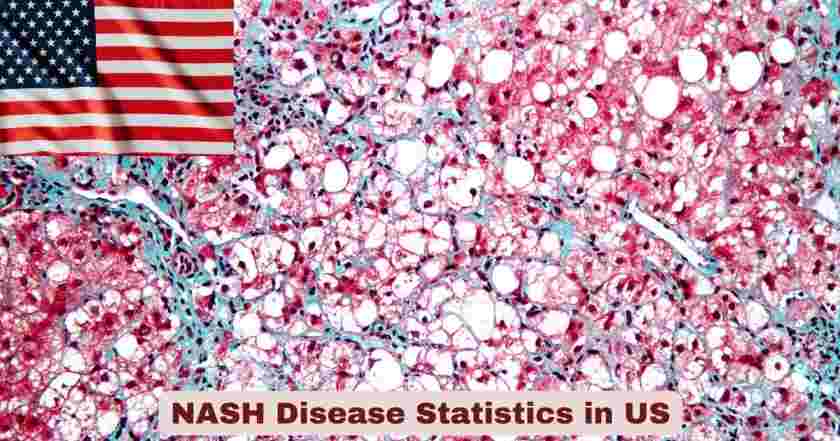 NASH Disease Statistics in US
