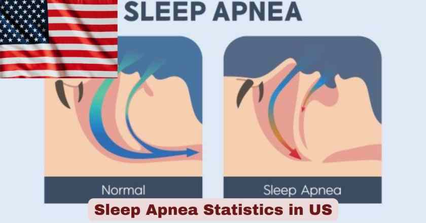 Sleep Apnea Statistics in US