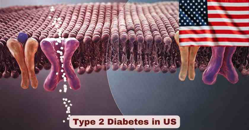 Type 2 Diabetes in US